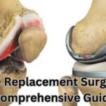 Knee Replacement Surgery