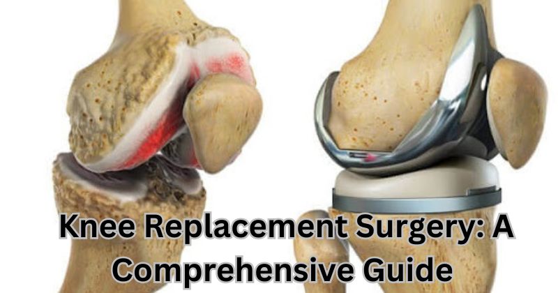 Knee Replacement Surgery