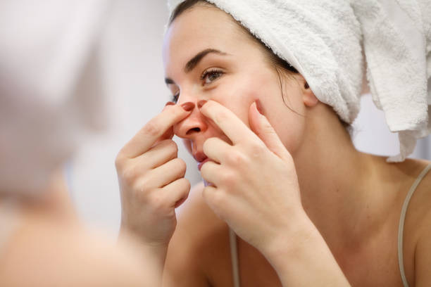 What Are the Causes of Acne and Treatment?