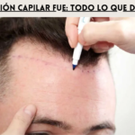 restauración capilar FUE