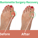 tailor bunion surgery recovery