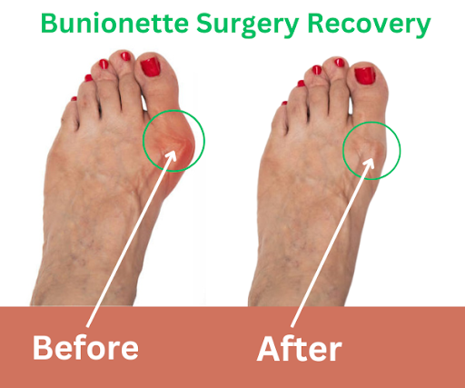 tailor bunion surgery recovery