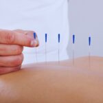 Acupuncture