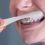 Powerful Tips for a Clean & Healthy Smile with Braces